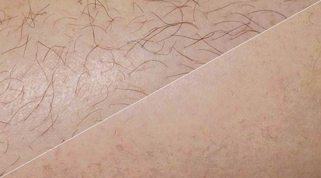 Laser Hair Removal - Huntingdon - Melior Clinics