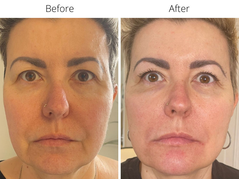 Marionette lines before and after dermal filler treatment
