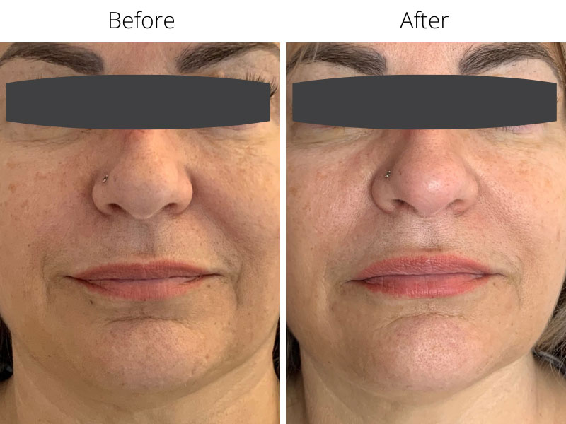 Marionette lines before and after Jalupro treatment