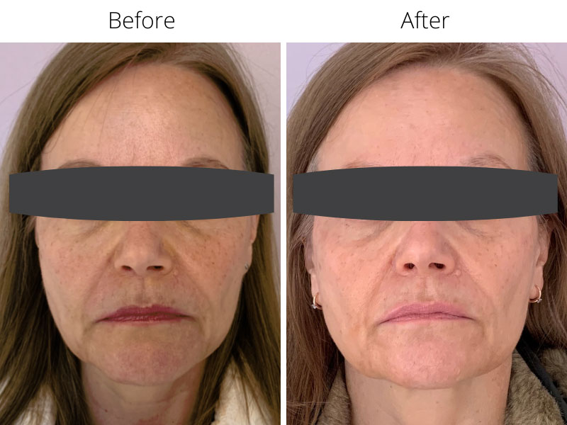 Marionette lines before and after Profhilo treatment