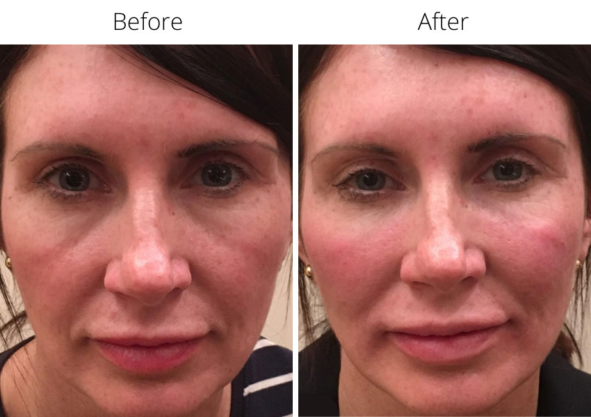Before and after Juvederm Voluma