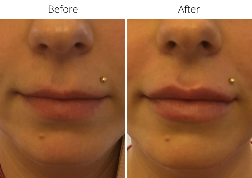 Before and after lip fillers