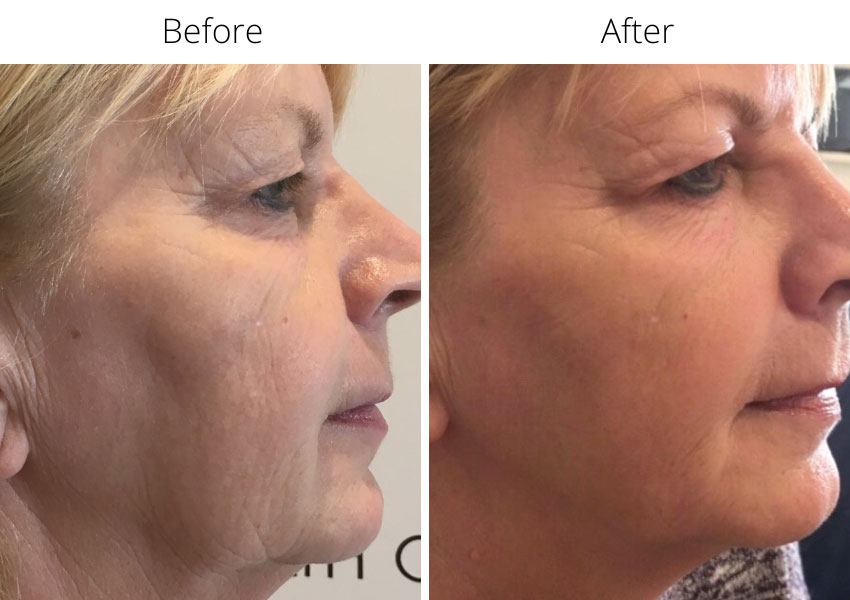 Before and after Profhilo treatment