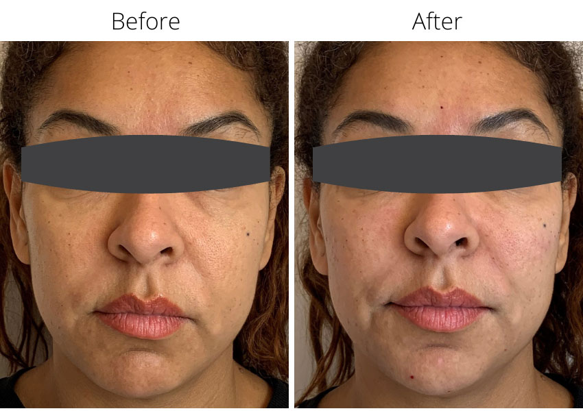 Before and after Juvederm Voluma