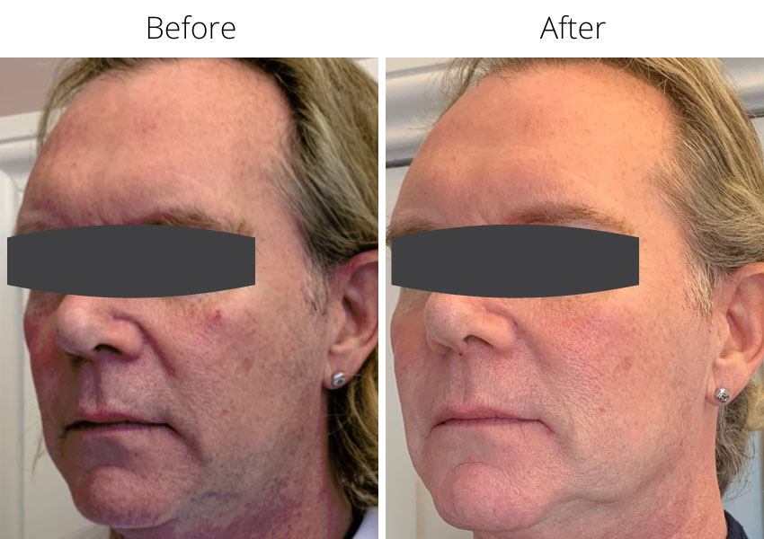 Before and after Profhilo treatment