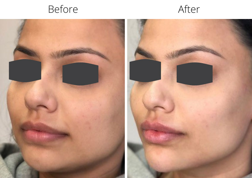 Before and after dermal fillers