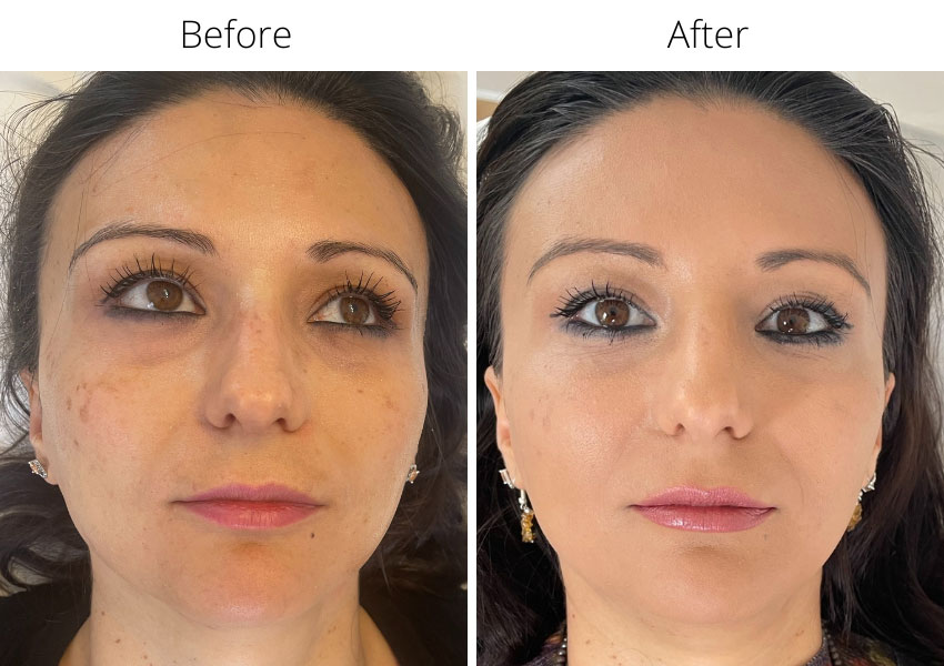 Before and after dermal fillers and botox