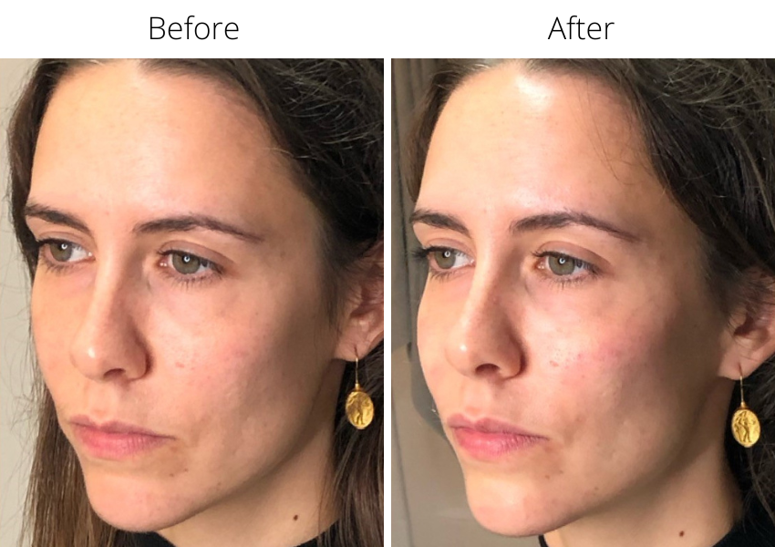 Before and after dermal fillers treatment
