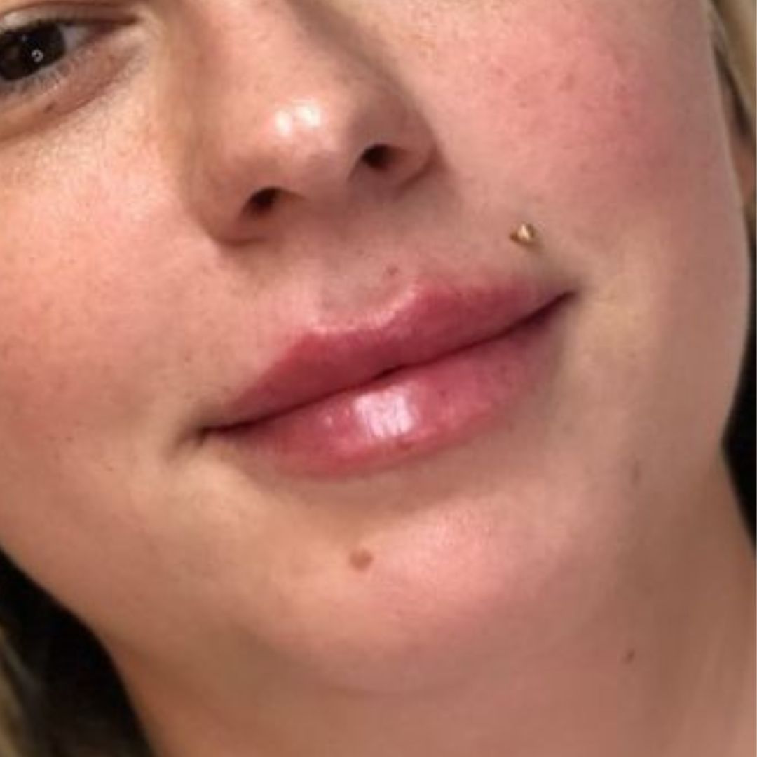 After image of lip filler