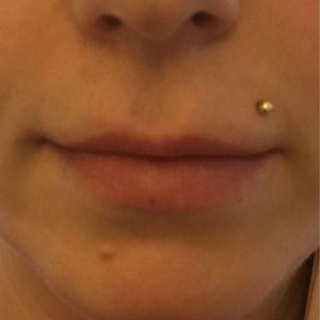 Before image of lip filler