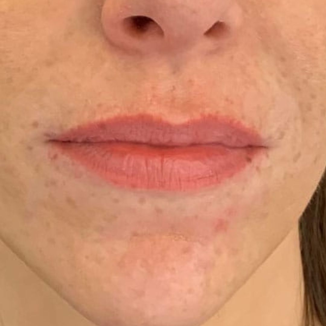 image before lip filler