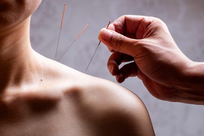 Woman getting acupuncture in shoulder