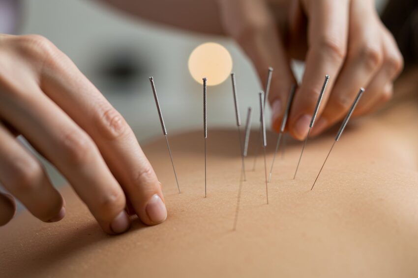 Acupuncture treatment for the back