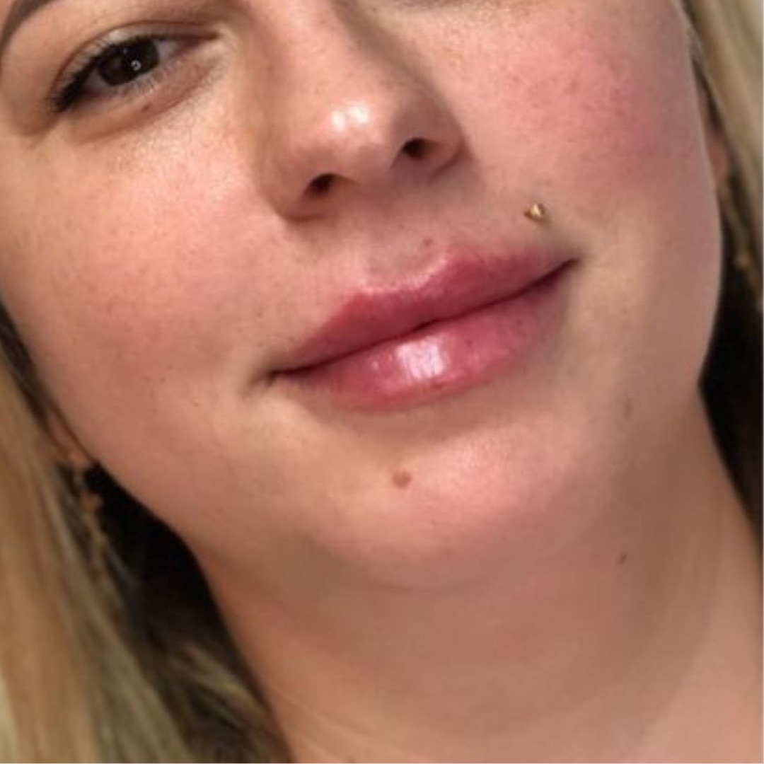 after image of lip filler