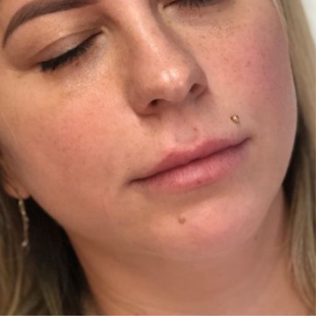 before image of lip filler