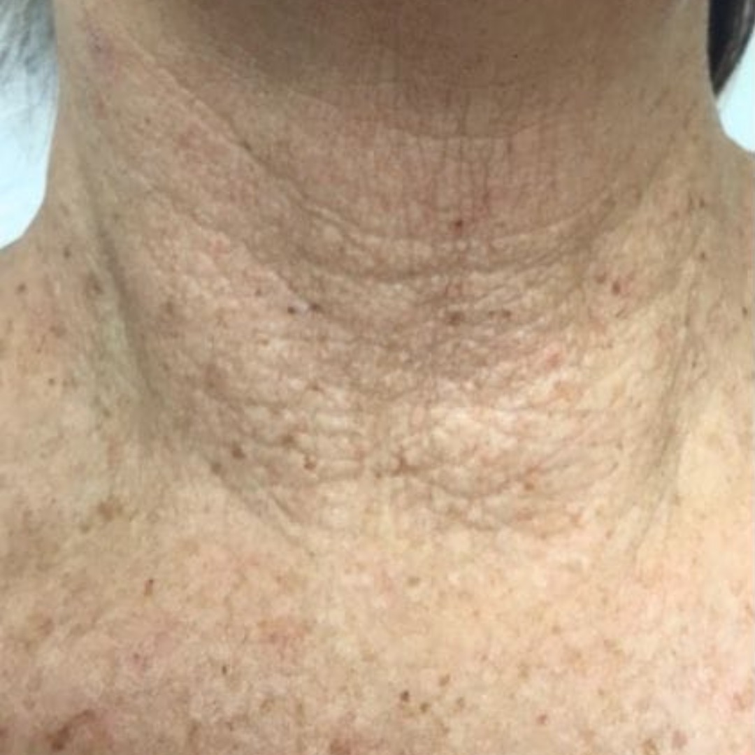 Image of woman's neck before sunekos