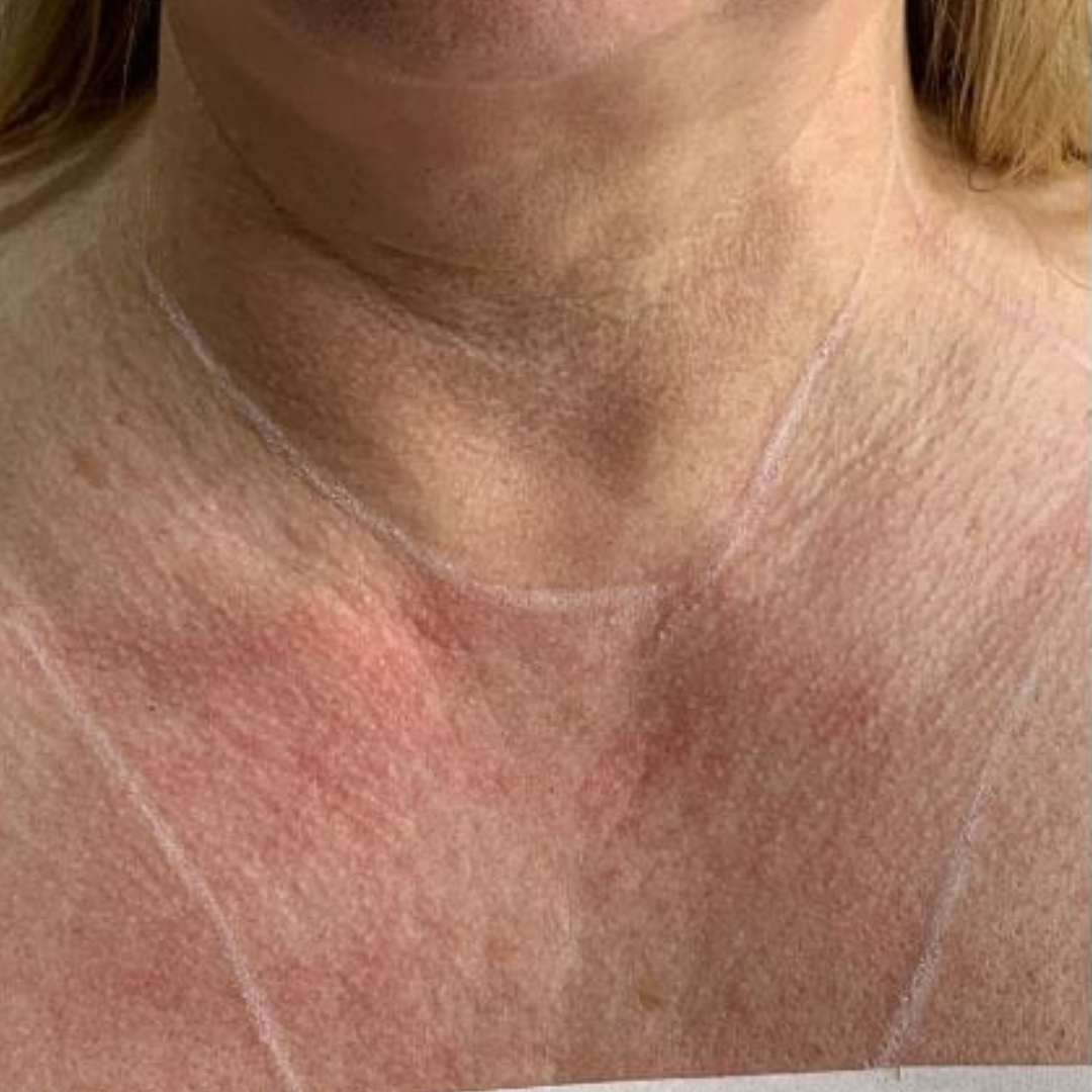 Before and after Jalupro skin boosters