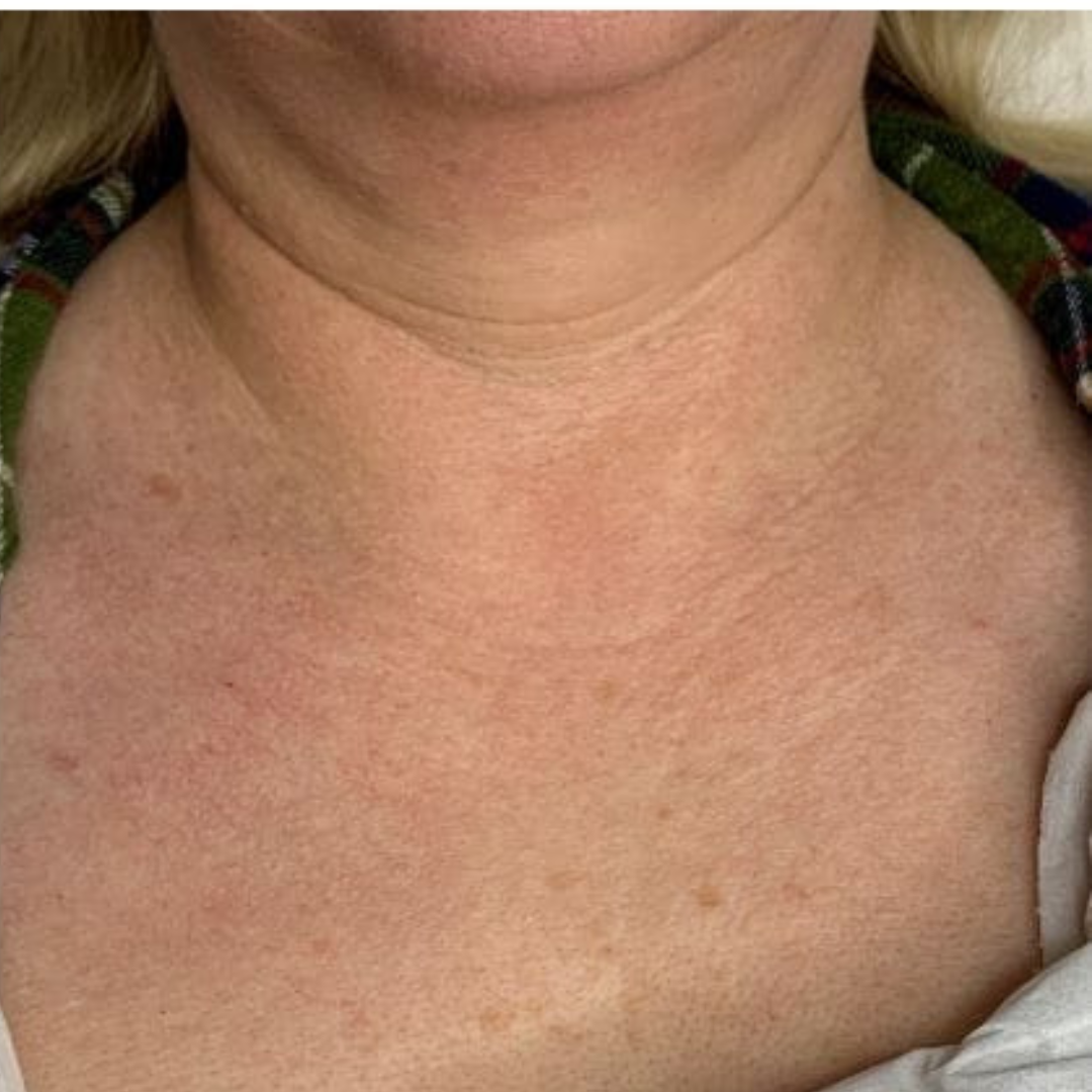 Before and after Jalupro skin boosters