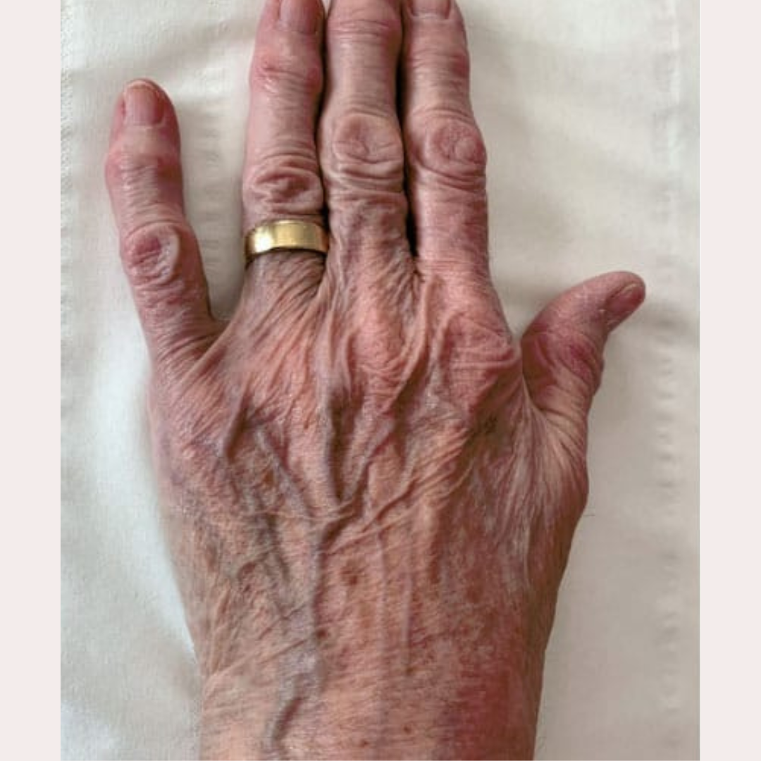 Before and after Jalupro skin boosters