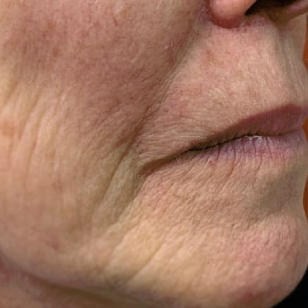 Before and after Jalupro skin boosters