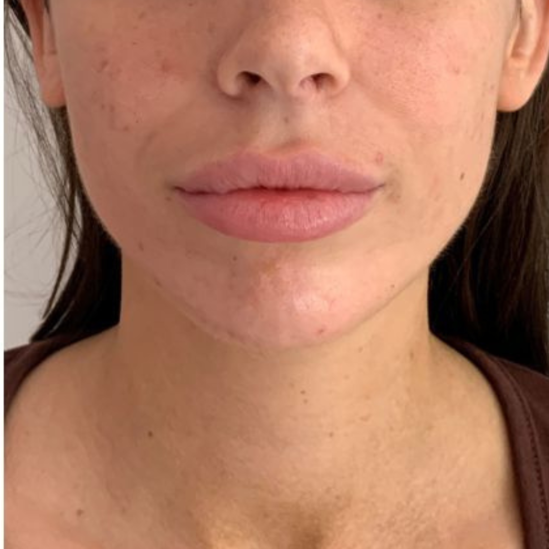 Jaw filler patient at our Sevenoaks clinic.