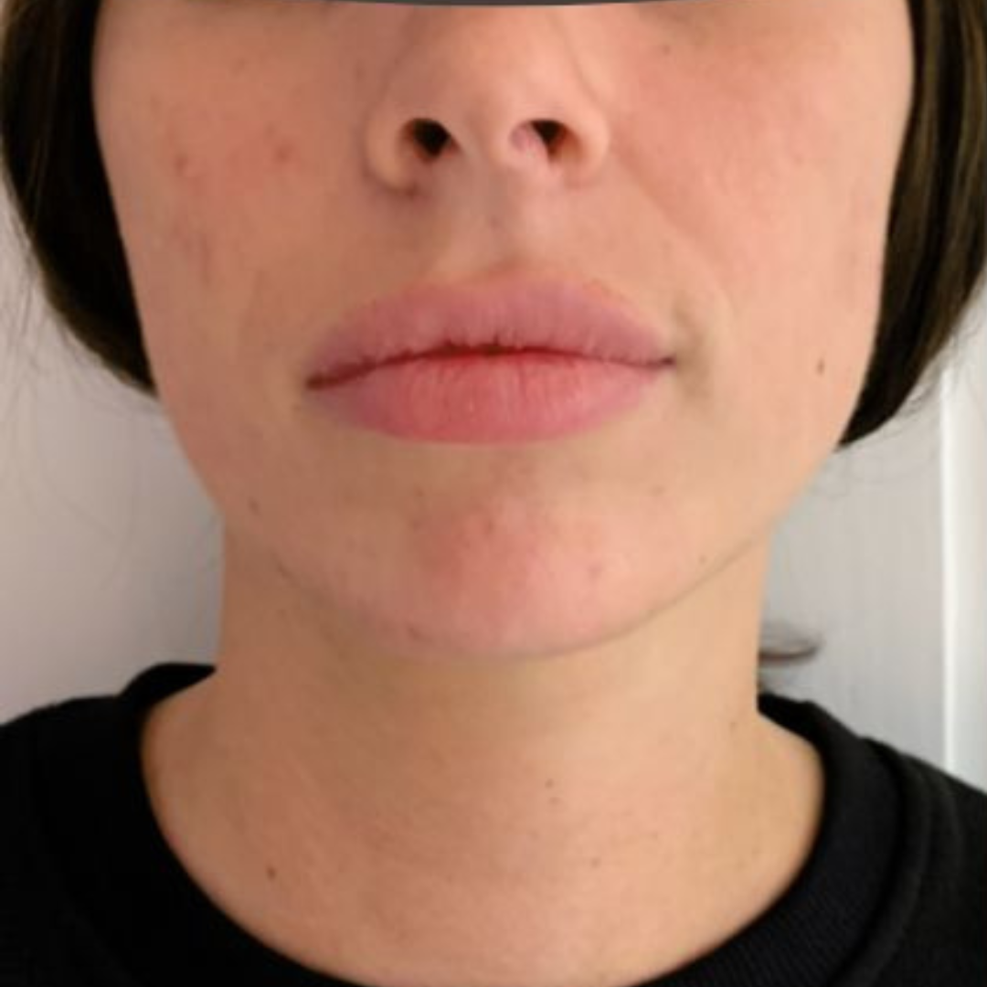 Jaw filler patient at our Sevenoaks clinic.