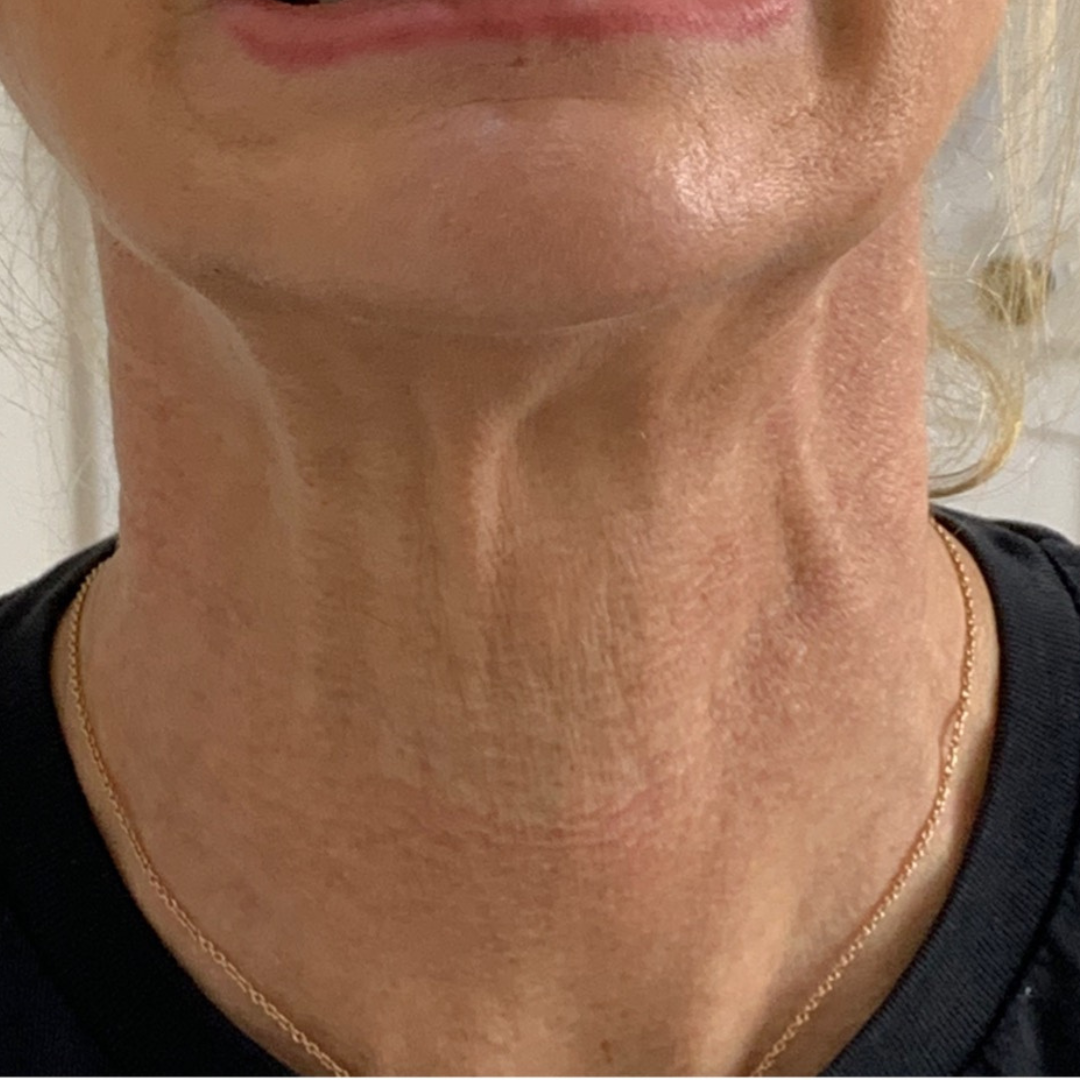 Neck filler patient at our Sevenoaks clinic.
