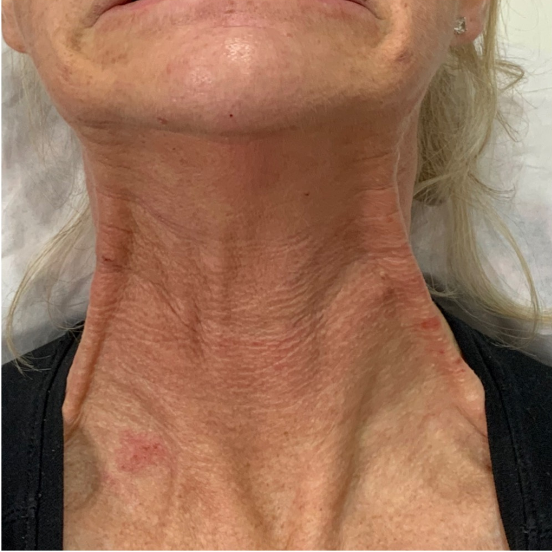 Neck filler patient at our Sevenoaks clinic.
