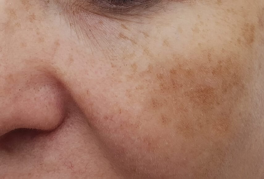 Close up image of woman's face showing her hyperpigmentation spots on her cheek