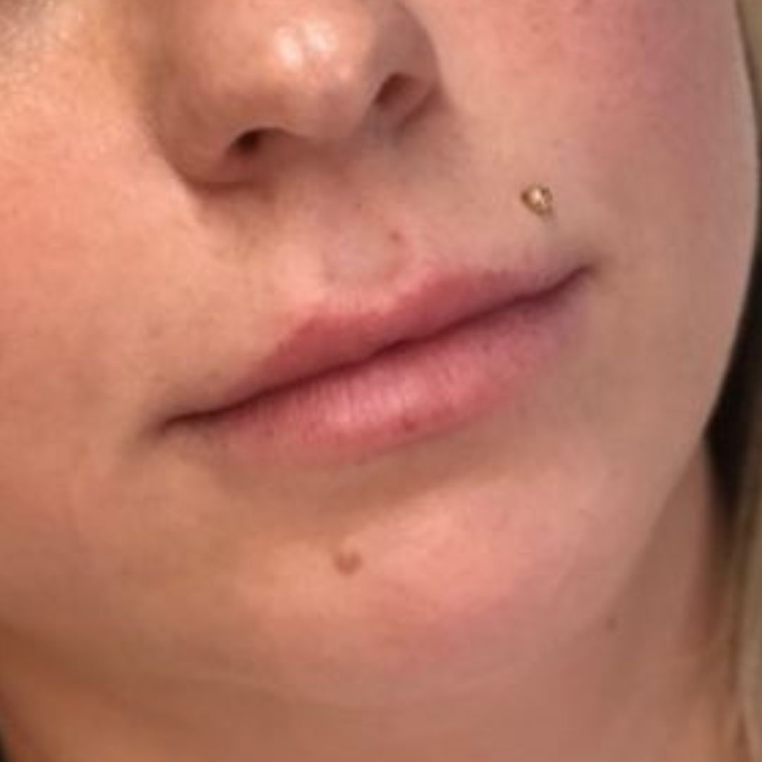 Image of woman before lip filler