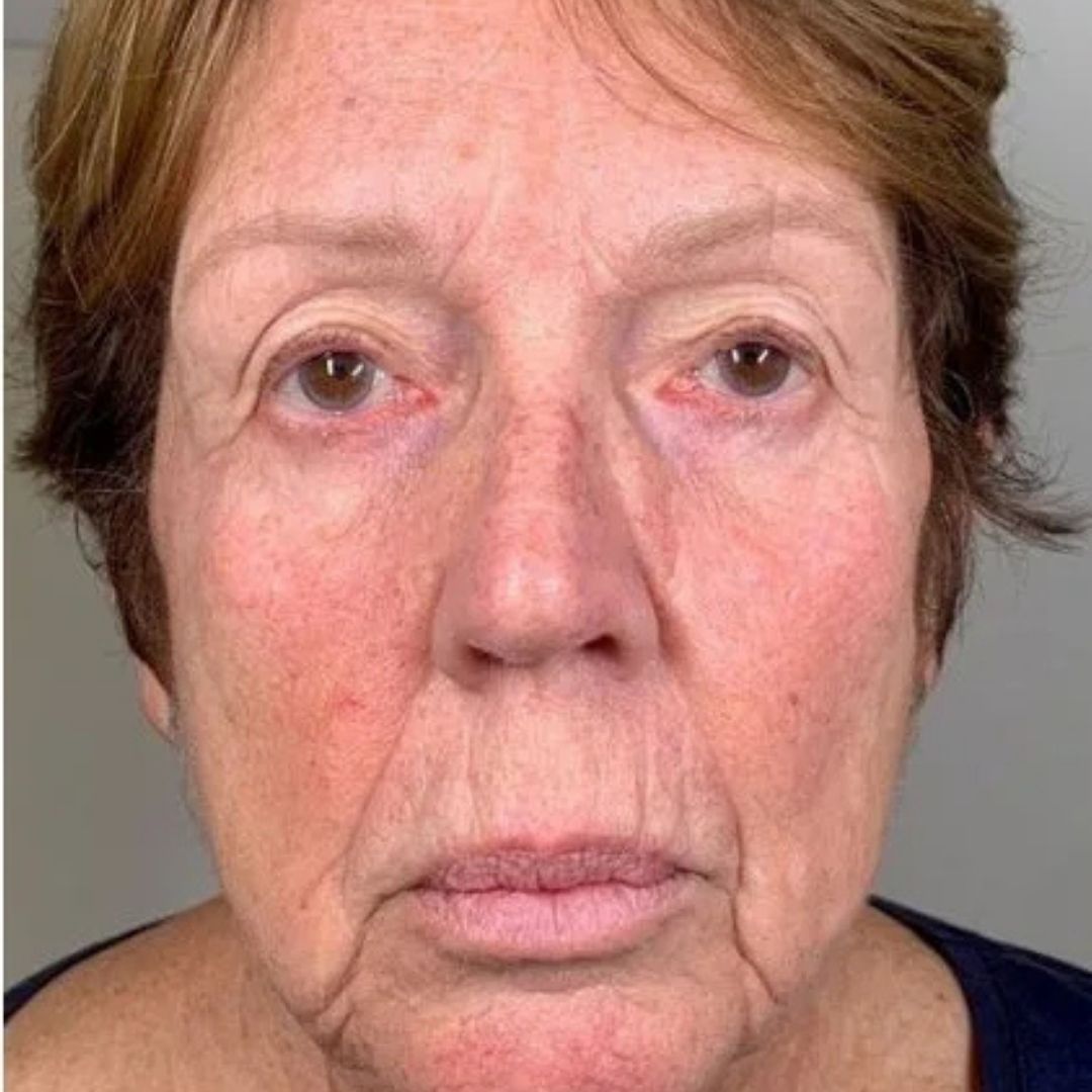 After Potenza treatment