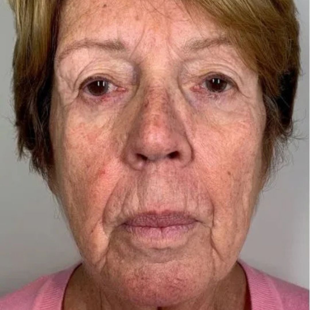 Before Potenza treatment