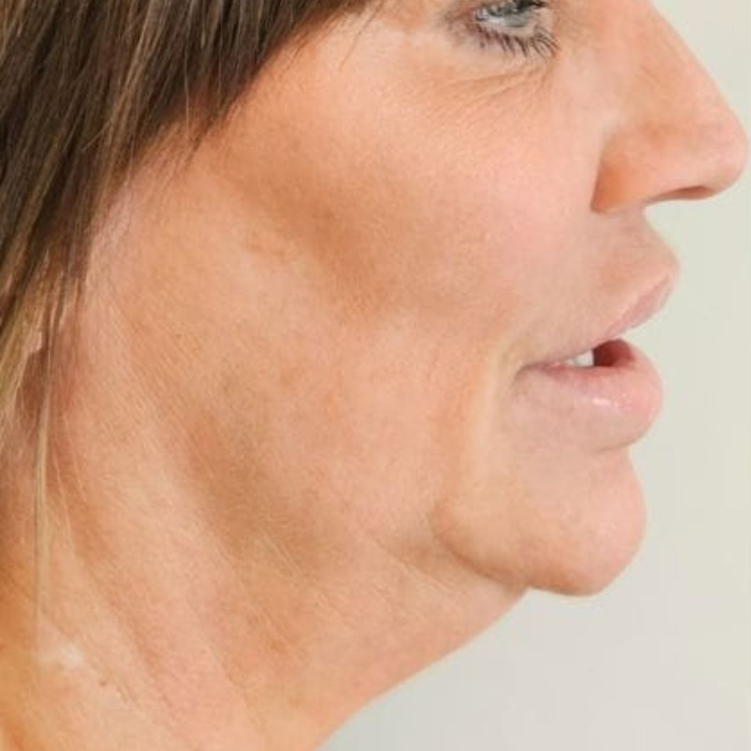 Before bespoke treatment