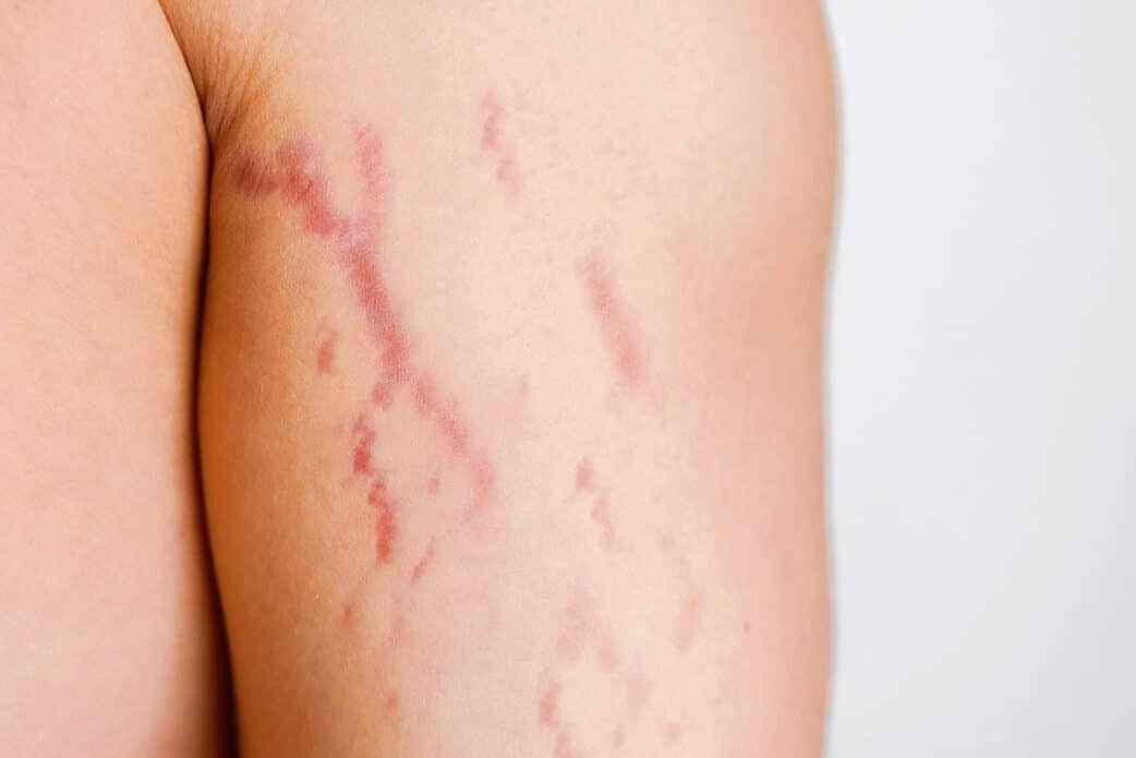 Red stretch marks on arm