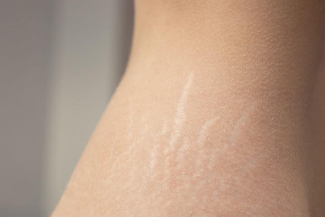 White stretch marks on arm