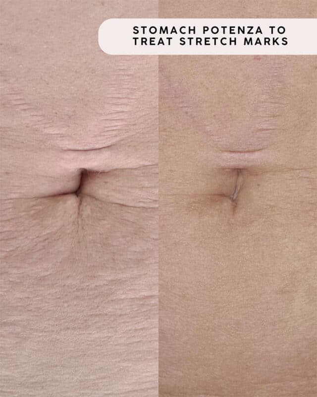Before and after treatment of stretch marks on stomach using Potenza microneedling