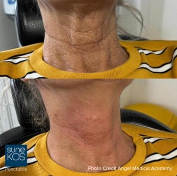Before and after Sunekos skin booster treatment