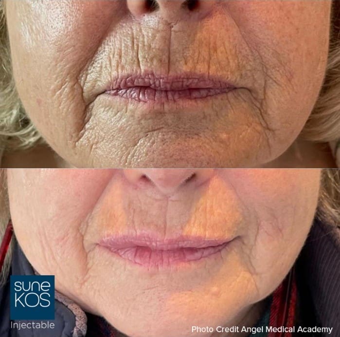 Before and after Sunekos skin booster treatment