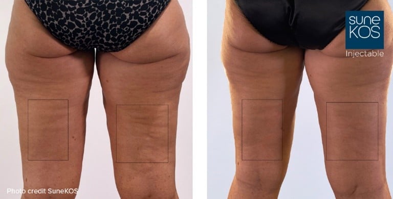 Before and after Sunekos skin booster treatment